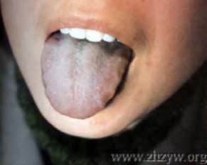 淡红齿痕舌薄白滑润苔