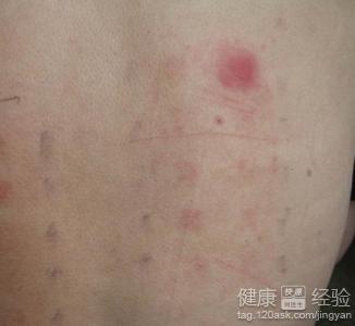 脂溢性皮炎痊愈后会不会留下疤痕