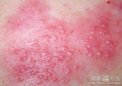 脂溢性湿疹与脂溢性皮炎的区别