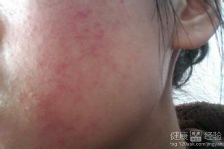脂溢性皮炎老是治不好,怎么办
