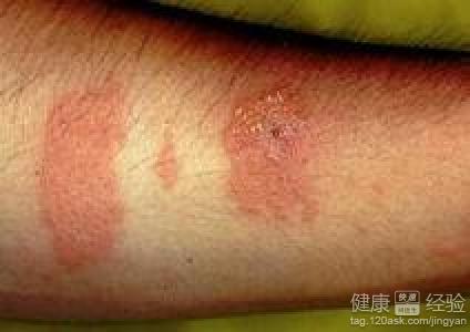 脂溢性皮炎如何治愈?