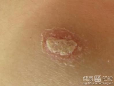 银屑病脂溢性皮炎会感染其它伤口吗