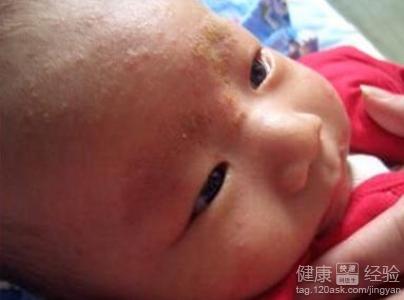 三个月的宝宝得脂溢性皮炎能用药吗