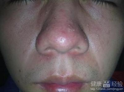 脂溢性皮炎和痘痘有啥区别?