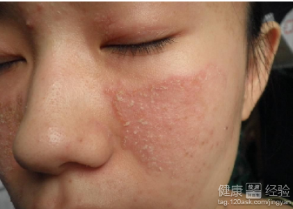 患上脂溢性皮炎怎么办?