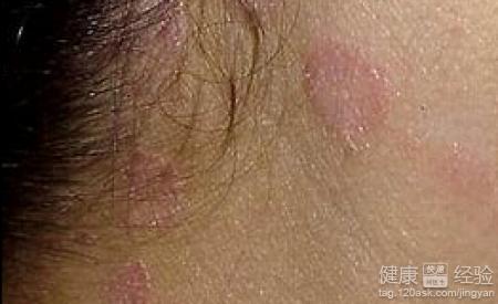 脂溢性皮炎在饮食上需要注意什么?