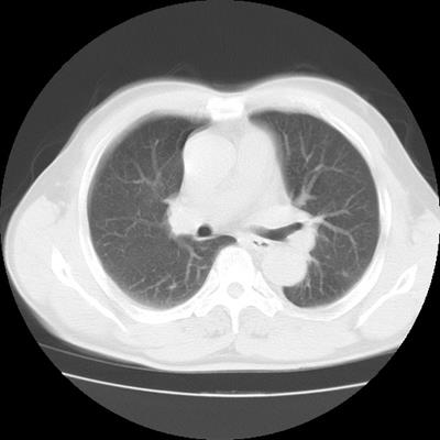 肺癌晚期症状ct图片