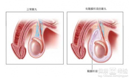 鞘膜积液分为哪几类