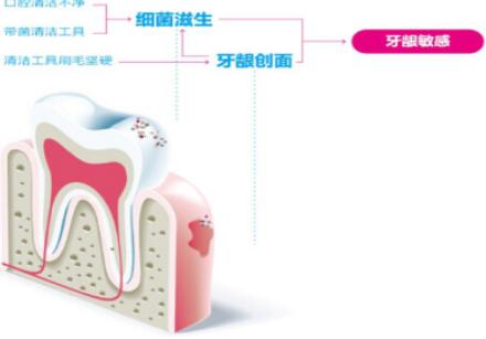 牙龈敏感如何刷牙 牙膏牙刷怎么选